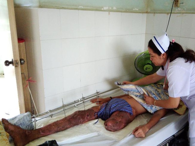 Bị đoạn chi vì bạn táy máy tay chân