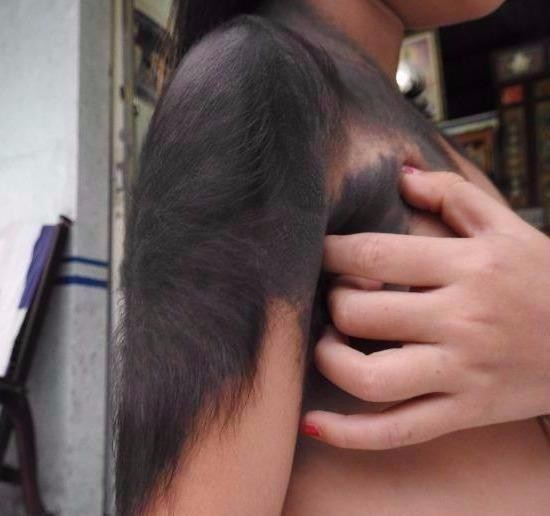 Cơ hội chữa bệnh miễn phí cho bé gái 'người sói'
