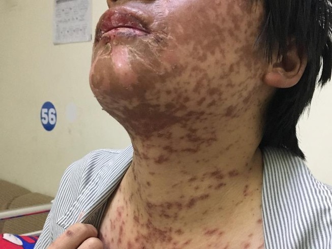 Mề đay nổi từng dề do tùy tiện uống thuốc cảm