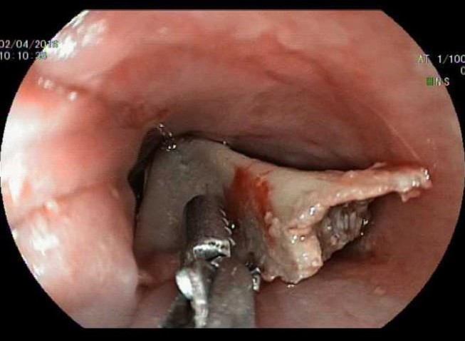 Bé gái 13 tuổi mắc xương đùi gà bự chảng trong cổ họng