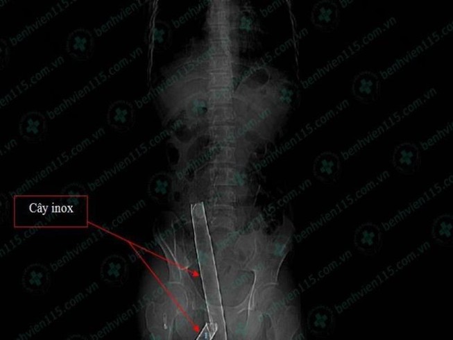 Vô bệnh viện cùng cây inox dài hơn 1m xuyên qua mông