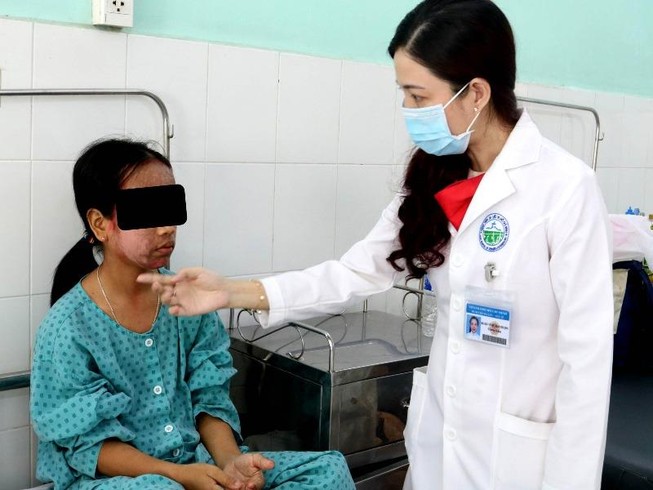 Mặt mũi banh chành vì thoa kem lột da mua trên mạng