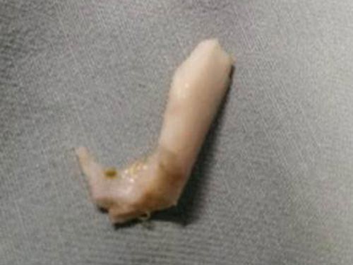 Loét thực quản sau nhiều ngày hóc xương heo