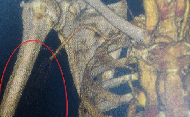 Tắc động mạch, suýt cắt bỏ tay mà cứ ngỡ đau xương
