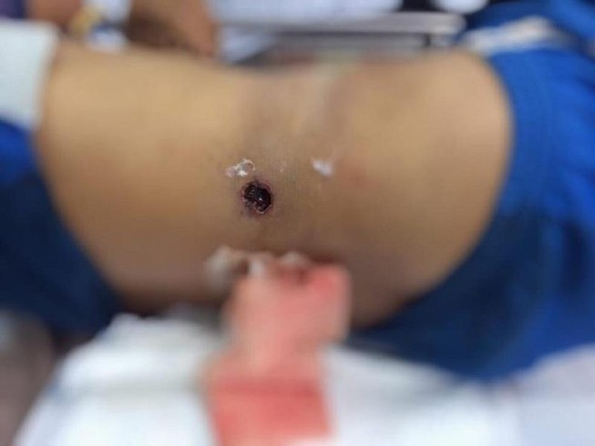 Đeo súng đi săn, súng cướp cò bắn thủng bụng nguy kịch