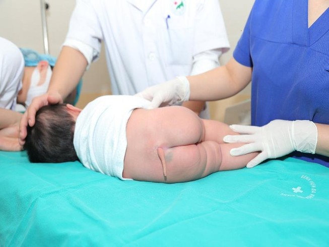 Hy hữu: Cắt đuôi bẩm sinh cho bé 5 tháng tuổi