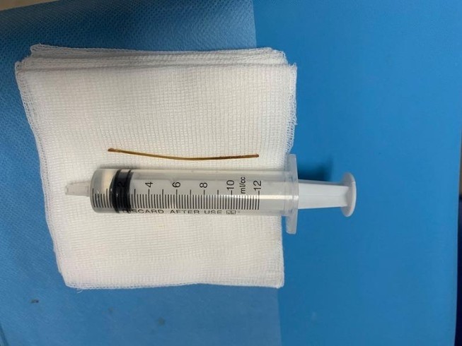 Tạo đường hầm trong bụng cứu bệnh nhân thích ngậm tăm đi ngủ