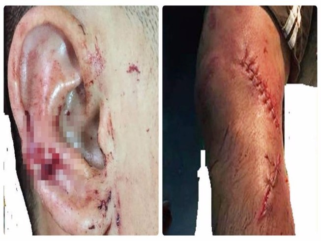 Vợ chém sứt tai và đứt gân chân chồng nhậu say