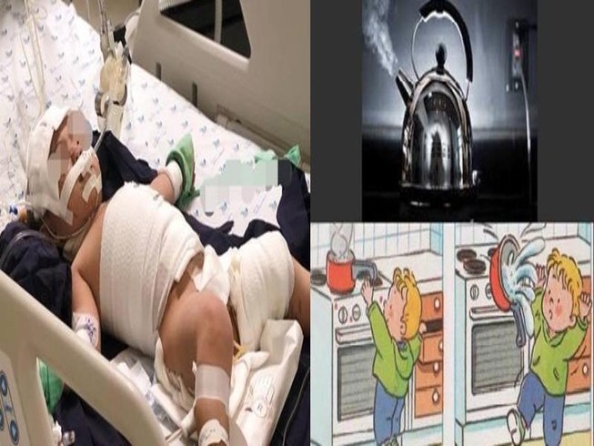 Mắc dây ấm đun siêu tốc, bé 20 tháng tuổi bỏng nặng
