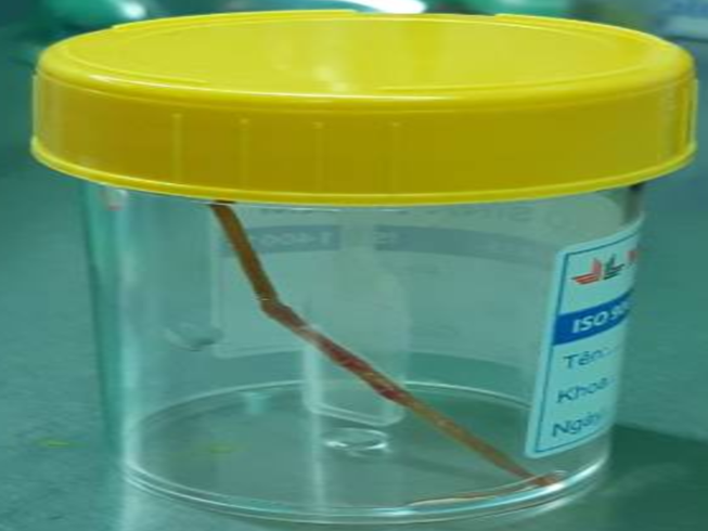 Hoãn mổ tim vì tăm tre 6 cm đâm thủng ruột