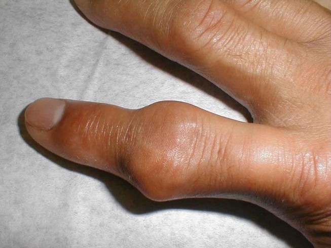 90% người bệnh gút đang lạm dụng thuốc có corticoid
