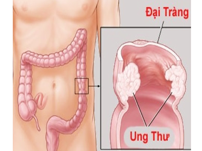 Làm sao để phòng tránh ung thư đại trực tràng?