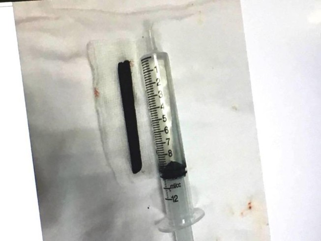 Bị đâm nửa chiếc đũa 9 cm vào mũi, sau 4 năm mới hay