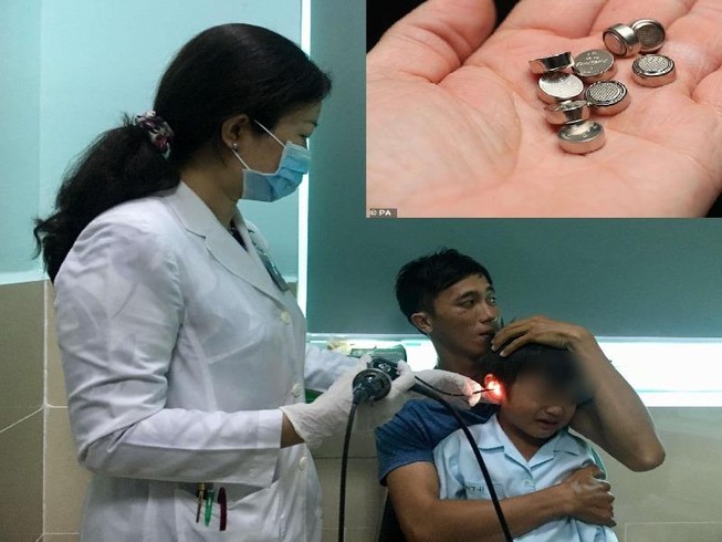 Nhét pin điện tử vào tai, bé trai năm tuổi thủng màng nhĩ