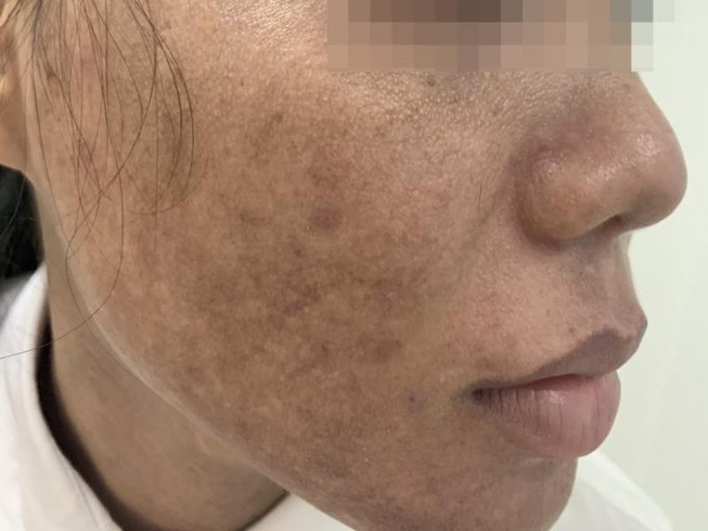 Trẻ hóa da bằng laser: Coi chừng già và xấu hơn!