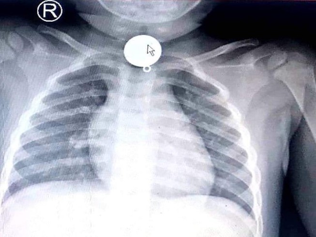 Trẻ tắc ống thực quản vì nuốt mặt dây chuyền