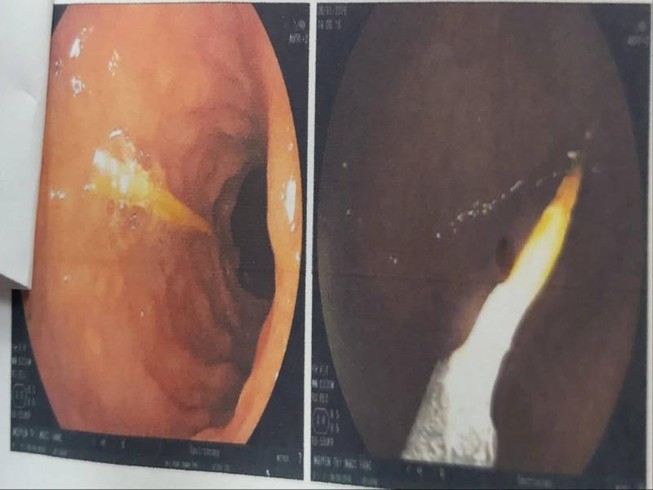 Bà đi pha sữa, bé 1 tuổi ngồi chơi nuốt tăm suýt thủng ruột