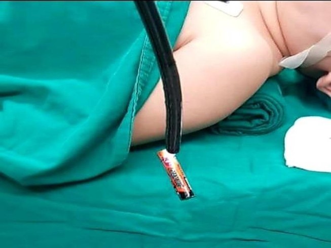 Nuốt xong cục pin, bé trai 4 tuổi nói ra cha mẹ mới hay