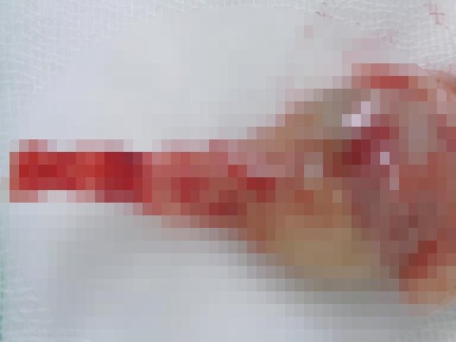 Phát hiện 1 thai nhi mắc hội chứng người cá