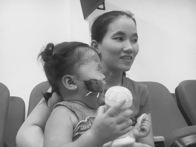 Bé trai bị chó cắn thương tích nặng khi đang ăn xúc xích