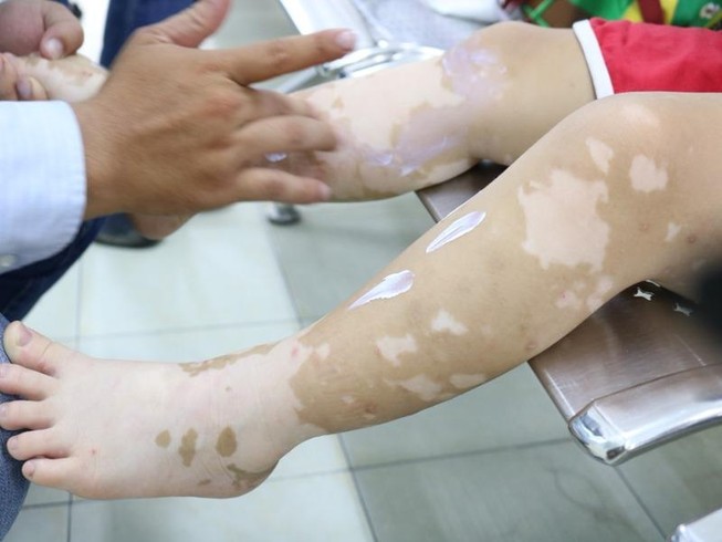 Tại sao da lại có những mảng trắng?