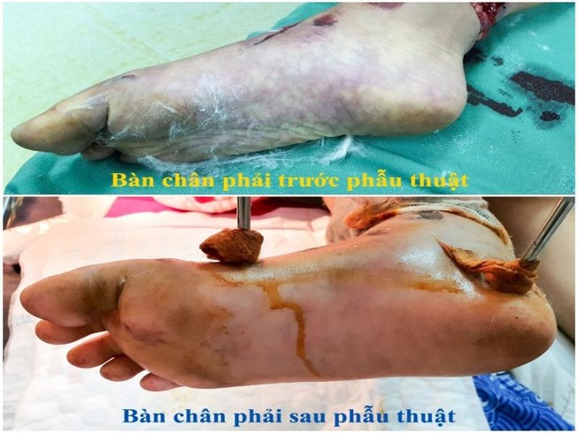 2 bệnh viện chạy đua cứu sống bàn chân bé gái