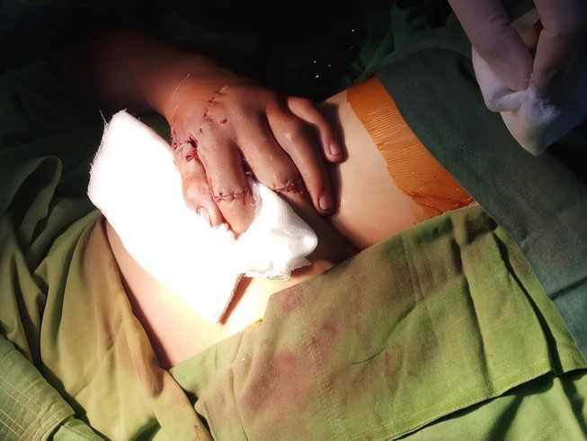Bệnh nhi suýt bị cắt bỏ bàn tay vì đốt pháo nổ tự chế