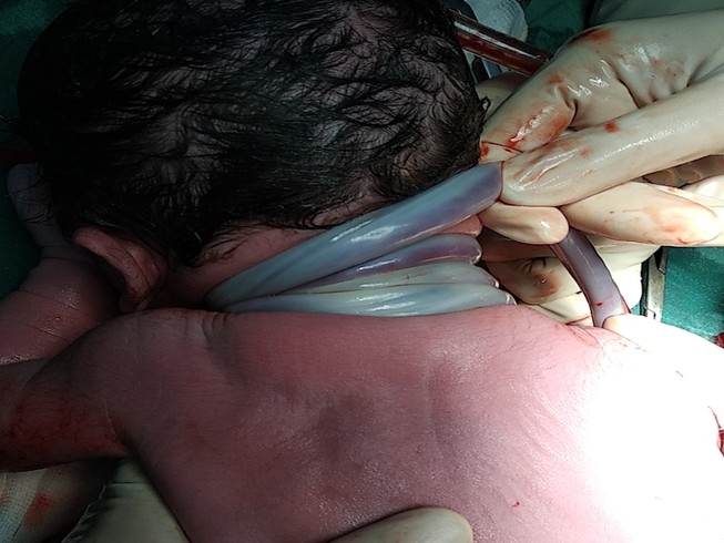 Cần Thơ: Bé trai chào đời với 4 vòng dây rốn quấn cổ