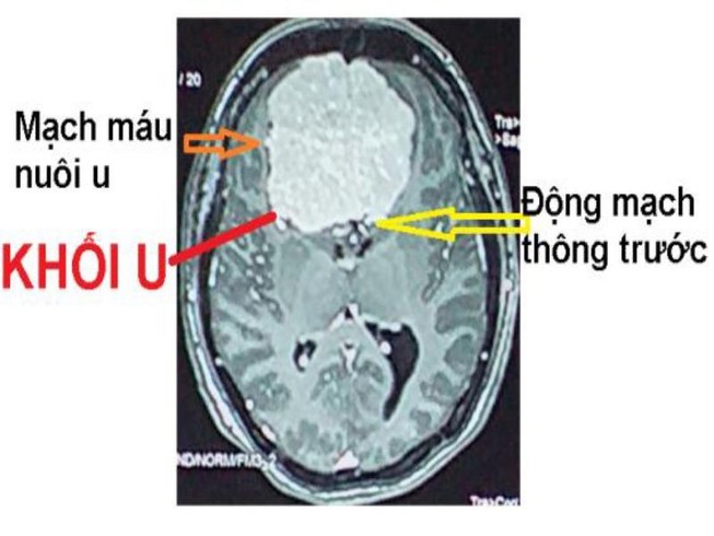 Khối u não khổng lồ. Ảnh: BVCC