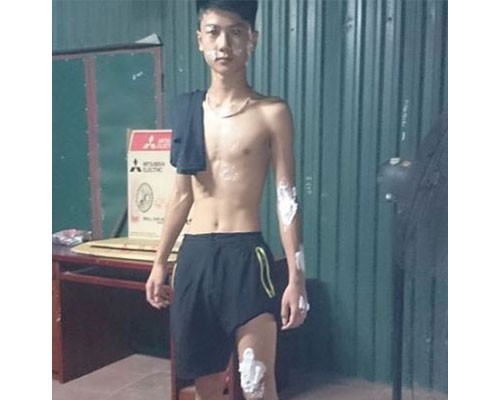 Trốn CSGT, xe chở axit gây bỏng hàng loạt người đi đường