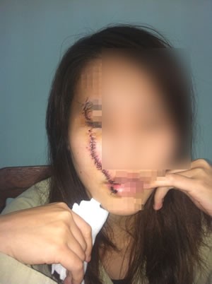 Cô gái bị rạch mặt khi uống nước mía bên đường