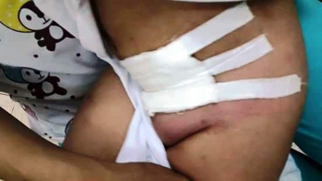 Bác sĩ chẩn đoán sai, một bé trai bị mổ oan
