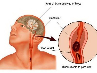 Tai biến mạch máu não: Phòng ngừa và chữa trị - ảnh 1
