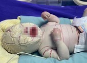 Quảng Ninh: Bé trai sinh non bị bệnh hiếm, vảy trắng toàn thân