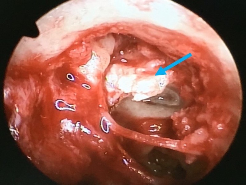 Bé gái bị khối cholesteatoma ăn mòn xương tai - ảnh 1