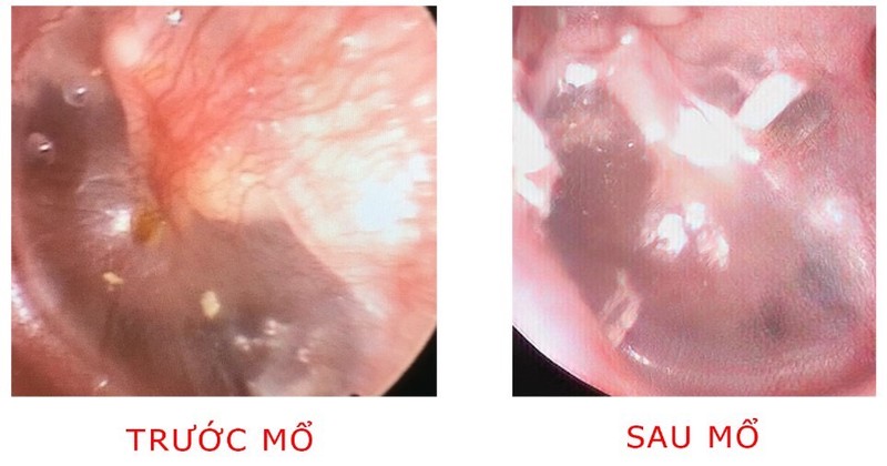 Bé gái bị khối cholesteatoma ăn mòn xương tai - ảnh 2