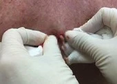 Nặn nhọt lọt ra... bệnh tiểu đường ảnh 2 Coi chừng mất mạng vì thói quen nặn mụn