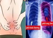 3 bệnh viện hợp sức cứu cô gái 'ngàn cân treo sợi tóc' ảnh 2 Ðau lưng phía sau phổi có phải dấu hiệu ung thư?