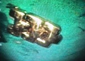 Bé trai 18 tháng suýt thủng ruột vì nuốt móc sắt kẹp áo ảnh 3 Dây đồng hồ kim loại 'chui tọt' vô bụng bé gái 3 tuổi