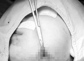 Mảnh đạn 40 năm nằm trong ổ bụng tạo ổ áp xe khổng lồ ảnh 4 Hóc xương cá lóc 5 ngày, cổ họng bé gái đầy ổ áp xe