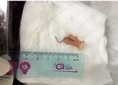 Khám sức khỏe, tá hỏa phát hiện răng giả mắc ở cổ 4 năm ảnh 3 Sặc... răng giả khi đang chạy xe máy