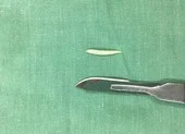 Bé trai 3 tuổi suýt chết vì mảnh xương cá sắc lẹm đâm vào vị trí hiểm ảnh 3 Hóc xương cá dứa, người phụ nữ nguy hiểm tính mạng