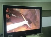 11 cây tăm trong bụng người đàn ông thích ngậm tăm khi ngủ ảnh 2 Người đàn ông bị tăm đâm thủng dạ dày, xuyên gan