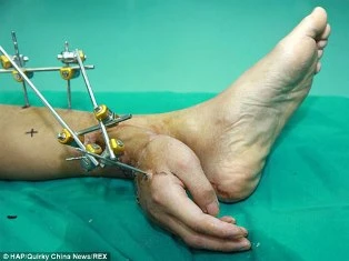 Bàn tay bị cắt rơi được nuôi từ mắt cá chân ảnh 1 Bàn tay bị cắt rơi được nuôi từ mắt cá chân ảnh 1