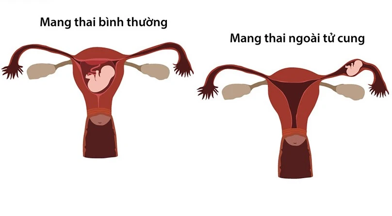 thai ngoài tử cung.jpg