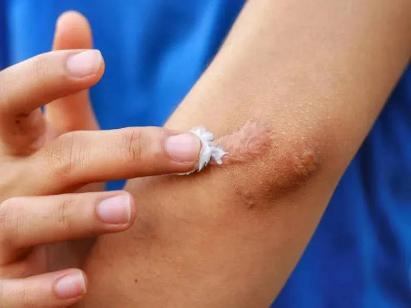 gel ngừa sẹo