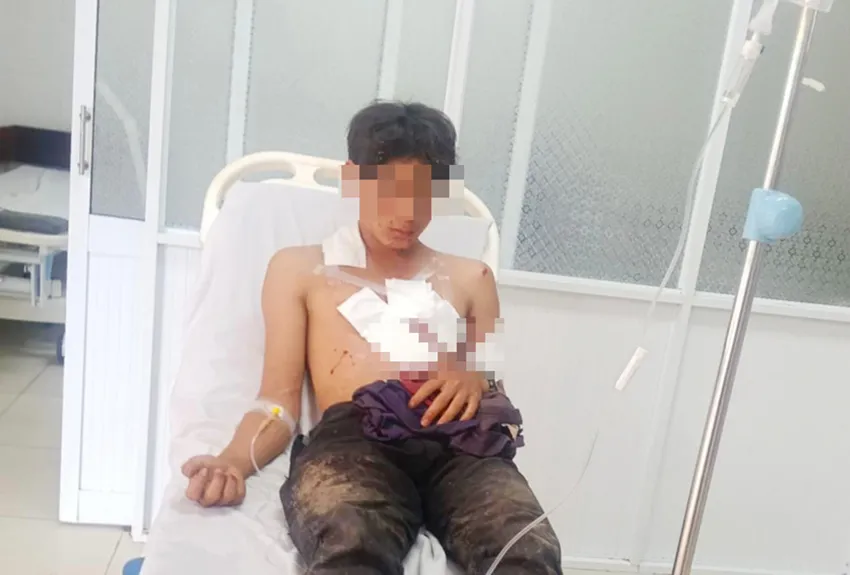 Hai thanh niên mang mìn tự chế đi đánh cá bị nổ gây thương tích, dập nát bàn tay