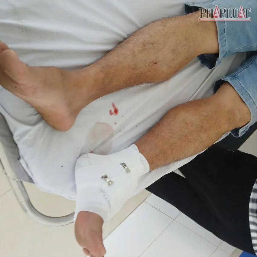 Vết thương của thầy T bị cá sấu cắn. 1000081866.jpg