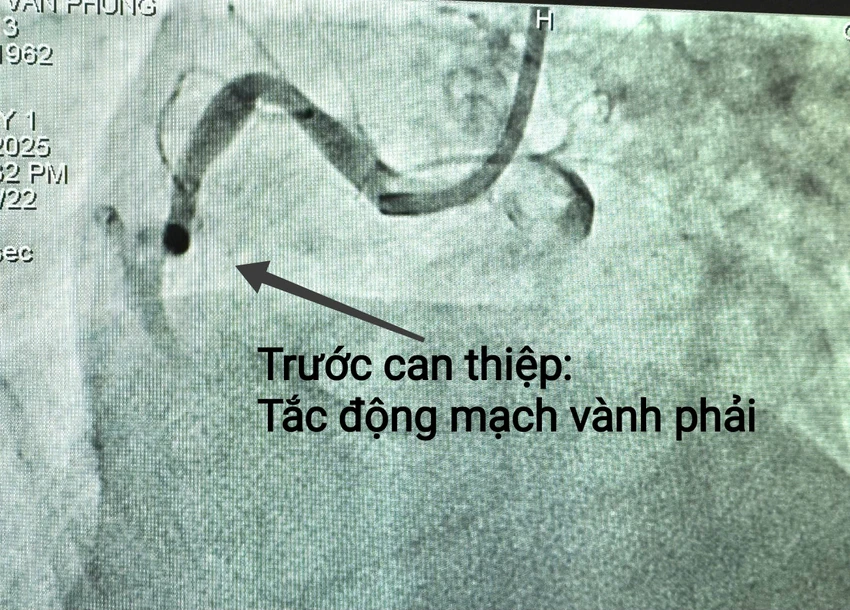 Hình ảnh tổn thương bệnh mạch vành, nhồi máu cơ tim của bệnh nhân P trước can thiệp. Ảnh: BVCC bệnh viện đa khoa trung ương cần thơ nhồi máu cơ tim
