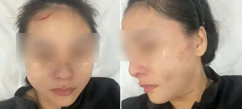 Nạn nhân bị xây xát trên mặt sau khi bị người đàn ông đánh. Ảnh: Si Nguyễn co-gai-thue-mat-bang-bi-nguoi-dan-ong-hanh-hung-giua-ban-ngay-o-tp-hcm-1.jpg